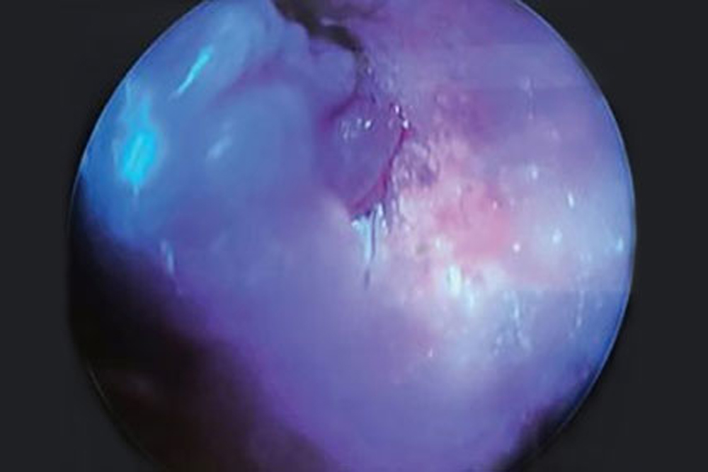 Veterinarian performing aural polyp removal procedure on a cat patient